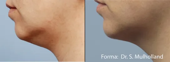 Forma Treatment Before and After