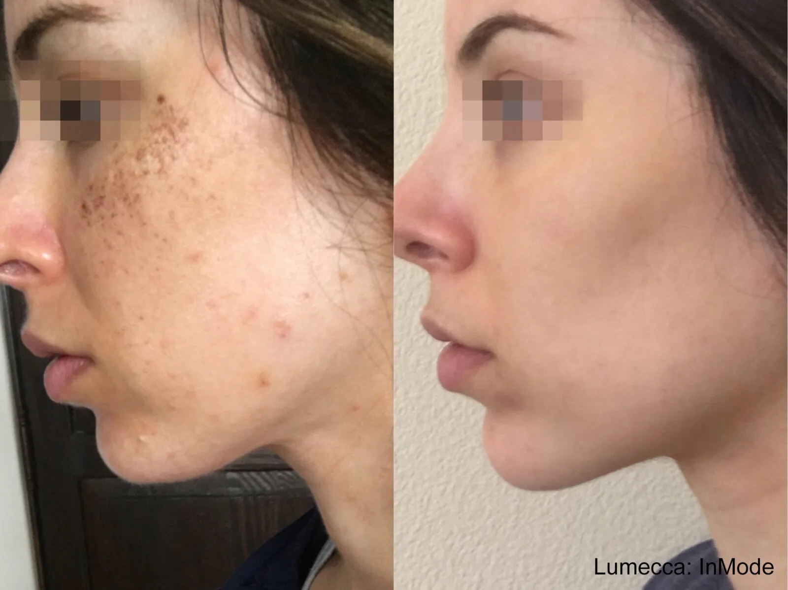 Lumecca Treatment Before and After